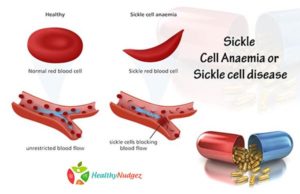 Sickle Cell Anaemia or Sickle cell disease - Best Dietician in Delhi